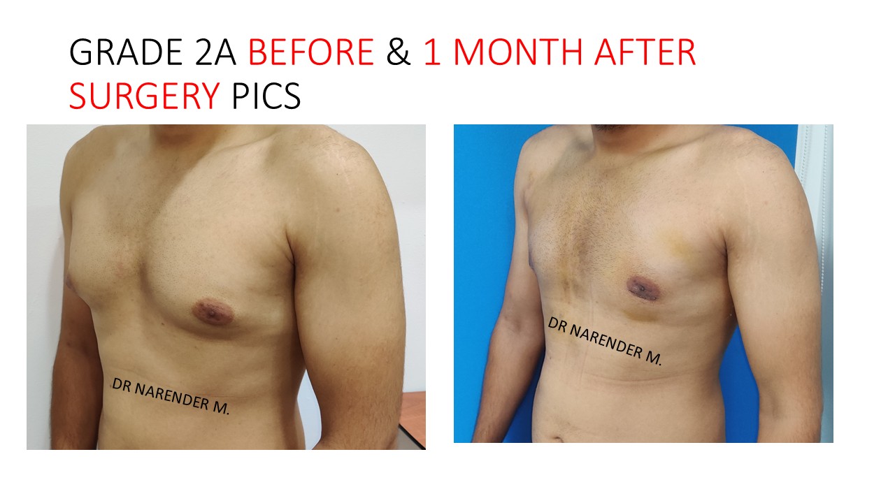 Gynecomastia Photo 2